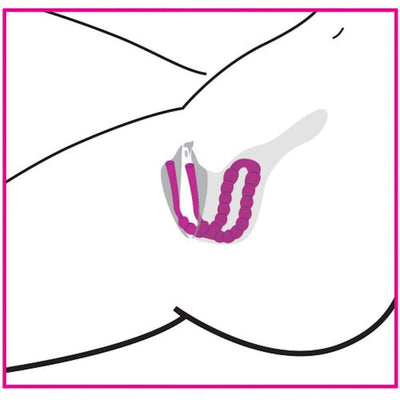Illustration of vaginal spreader inside of the vaginal canal