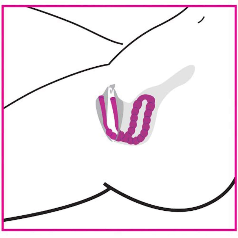 Illustration of vaginal spreader inside of the vaginal canal